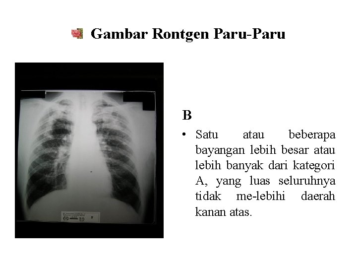 Gambar Rontgen Paru-Paru B • Satu atau beberapa bayangan lebih besar atau lebih banyak