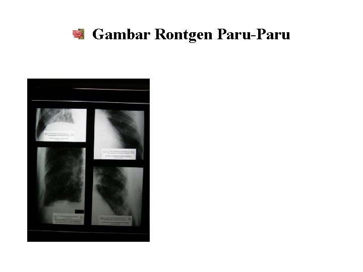 Gambar Rontgen Paru-Paru 