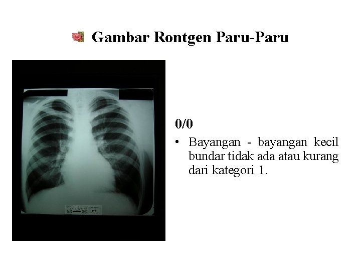 Gambar Rontgen Paru-Paru 0/0 • Bayangan - bayangan kecil bundar tidak ada atau kurang