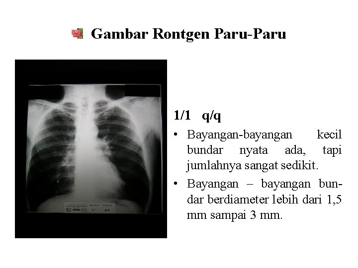 Gambar Rontgen Paru-Paru 1/1 q/q • Bayangan-bayangan kecil bundar nyata ada, tapi jumlahnya sangat