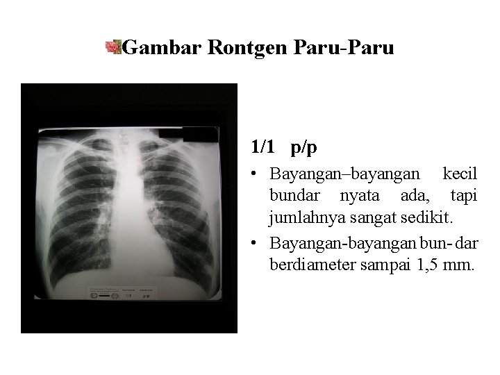 Gambar Rontgen Paru-Paru 1/1 p/p • Bayangan–bayangan kecil bundar nyata ada, tapi jumlahnya sangat