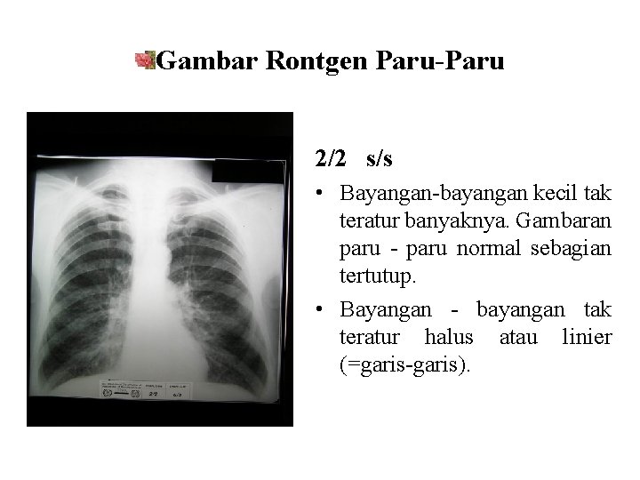 Gambar Rontgen Paru-Paru 2/2 s/s • Bayangan-bayangan kecil tak teratur banyaknya. Gambaran paru -