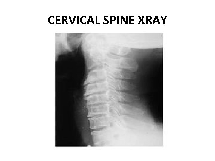 CERVICAL SPINE XRAY 