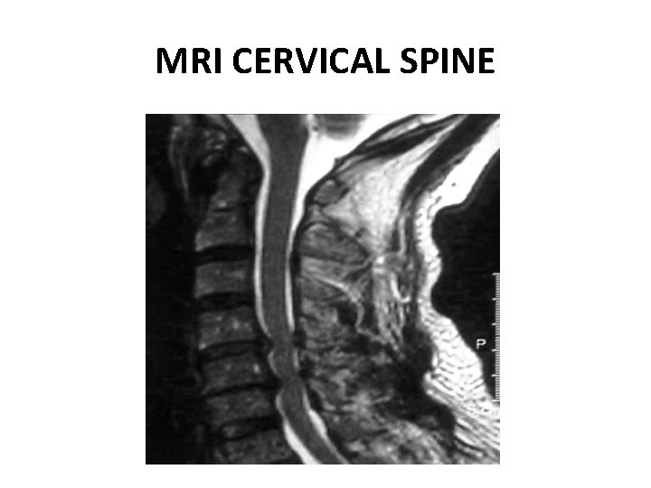 MRI CERVICAL SPINE 