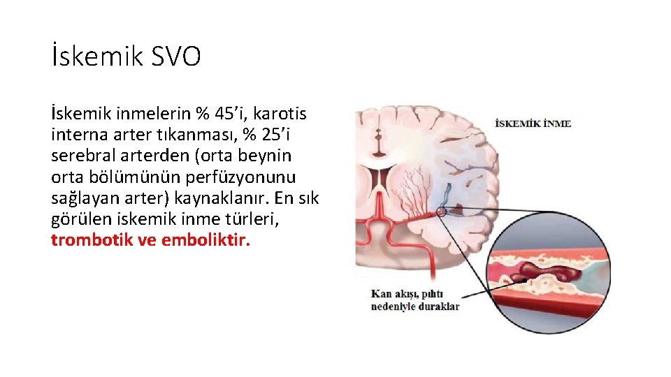 İskemik SVO İskemik inmelerin % 45’i, karotis interna arter tıkanması, % 25’i serebral arterden