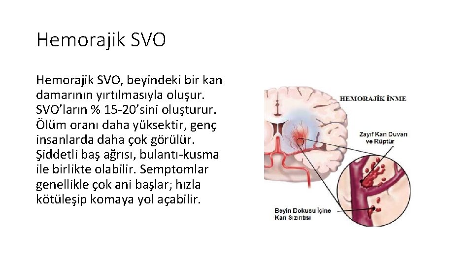 Hemorajik SVO, beyindeki bir kan damarının yırtılmasıyla oluşur. SVO’ların % 15 -20’sini oluşturur. Ölüm