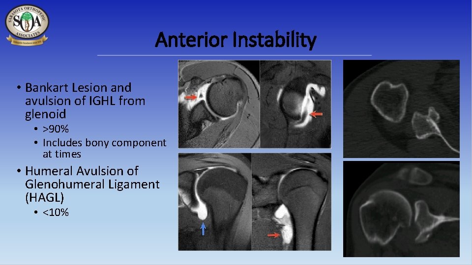 Anterior Instability • Bankart Lesion and avulsion of IGHL from glenoid • >90% •