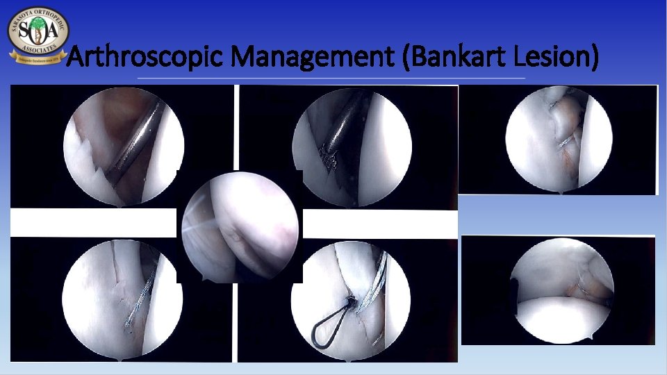 Arthroscopic Management (Bankart Lesion) 