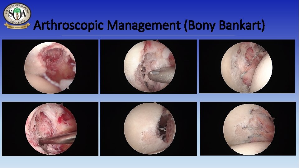 Arthroscopic Management (Bony Bankart) 