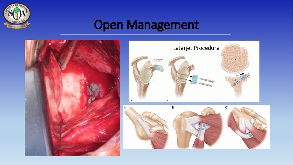 Open Management Latarjet Procedure 