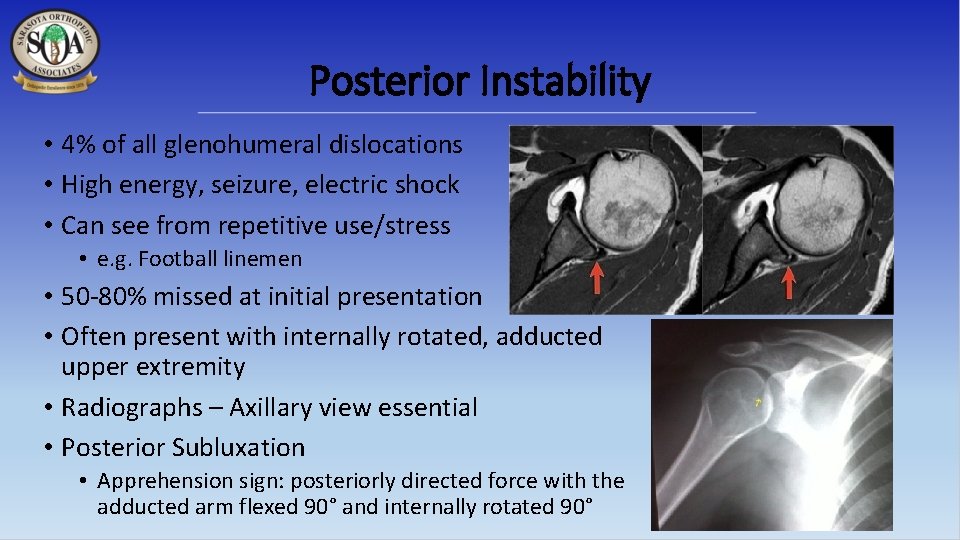 Posterior Instability • 4% of all glenohumeral dislocations • High energy, seizure, electric shock