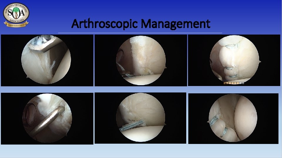 Arthroscopic Management 
