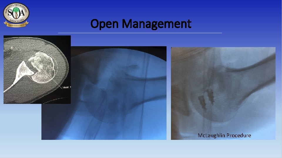 Open Management Mc. Laughlin Procedure 