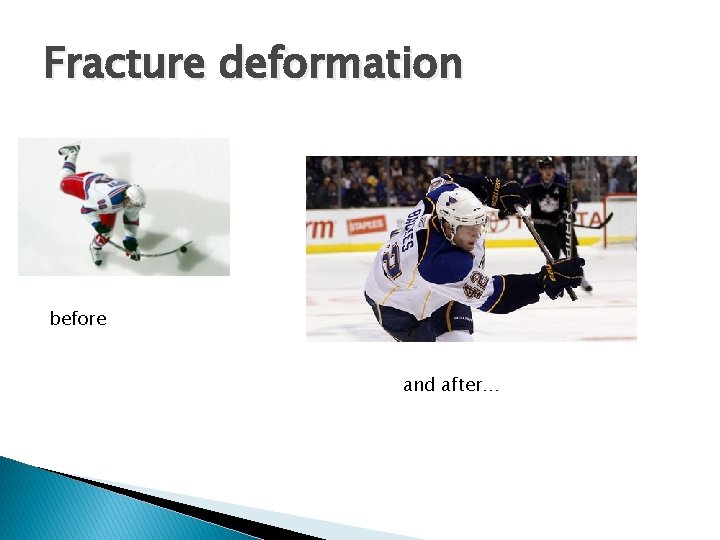 Fracture deformation before and after… 