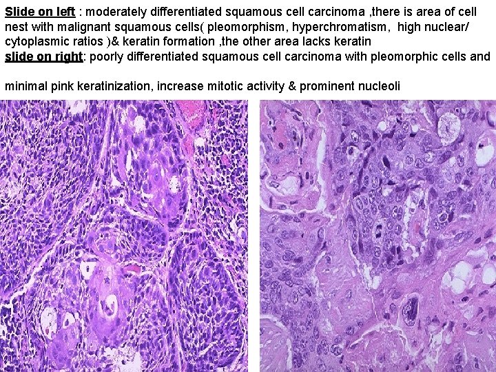 Slide on left : moderately differentiated squamous cell carcinoma , there is area of