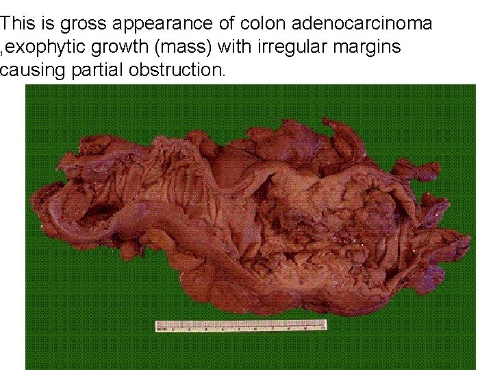 This is gross appearance of colon adenocarcinoma , exophytic growth (mass) with irregular margins