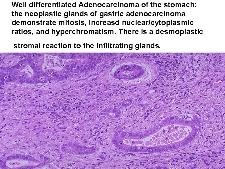 Well differentiated Adenocarcinoma of the stomach: the neoplastic glands of gastric adenocarcinoma demonstrate mitosis,