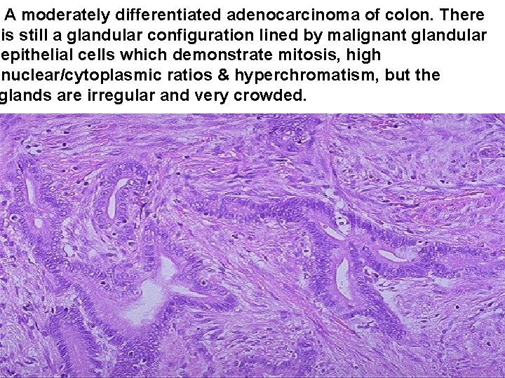 A moderately differentiated adenocarcinoma of colon. There is still a glandular configuration lined by