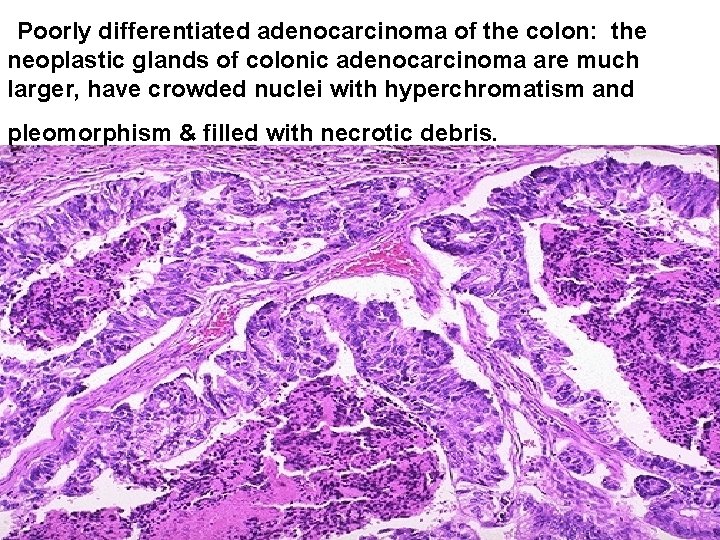Poorly differentiated adenocarcinoma of the colon: the neoplastic glands of colonic adenocarcinoma are much