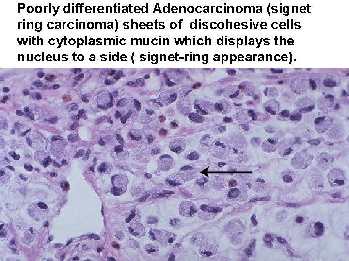 Poorly differentiated Adenocarcinoma (signet ring carcinoma) sheets of discohesive cells with cytoplasmic mucin which