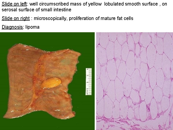 Slide on left: well circumscribed mass of yellow lobulated smooth surface , on serosal