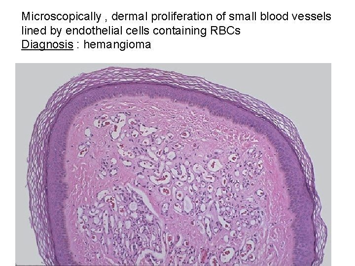 Microscopically , dermal proliferation of small blood vessels lined by endothelial cells containing RBCs