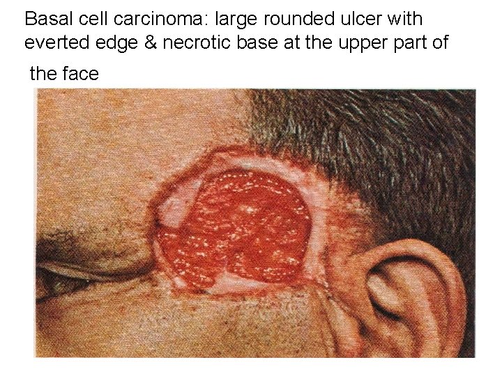 Basal cell carcinoma: large rounded ulcer with everted edge & necrotic base at the