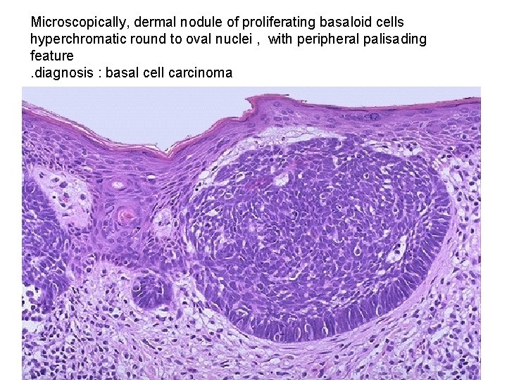 Microscopically, dermal nodule of proliferating basaloid cells hyperchromatic round to oval nuclei , with