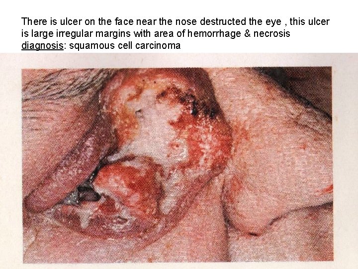 There is ulcer on the face near the nose destructed the eye , this