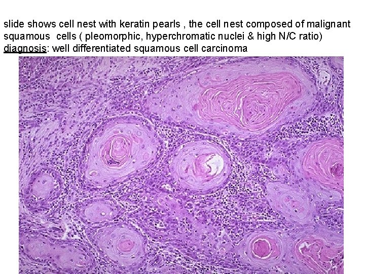 slide shows cell nest with keratin pearls , the cell nest composed of malignant