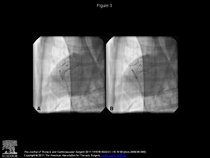 Figure 3 The Journal of Thoracic and Cardiovascular Surgery 2011 141518 -522 DOI: (10.