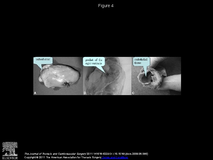 Figure 4 The Journal of Thoracic and Cardiovascular Surgery 2011 141518 -522 DOI: (10.