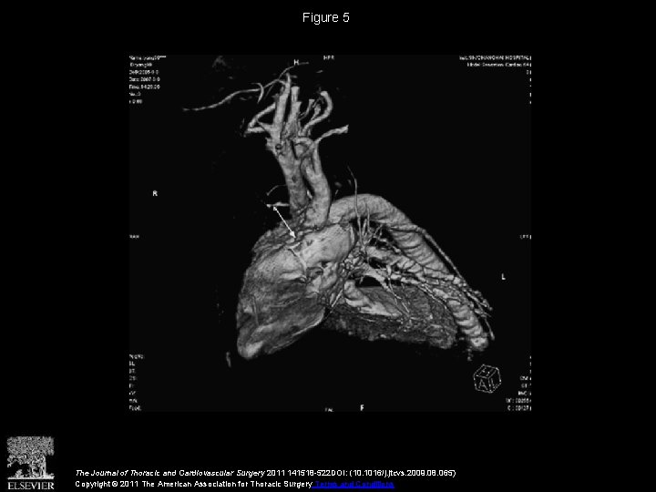 Figure 5 The Journal of Thoracic and Cardiovascular Surgery 2011 141518 -522 DOI: (10.