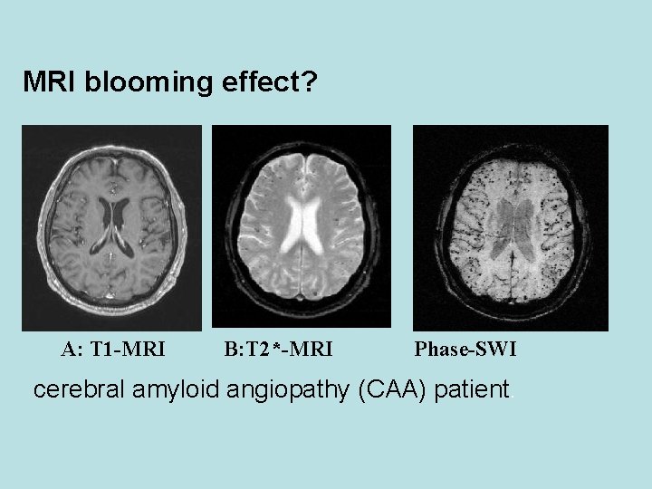 MRI blooming effect? A: T 1 -MRI B: T 2*-MRI Phase-SWI cerebral amyloid angiopathy