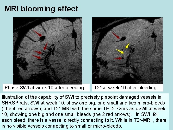 MRI blooming effect Phase-SWI at week 10 after bleeding T 2* at week 10