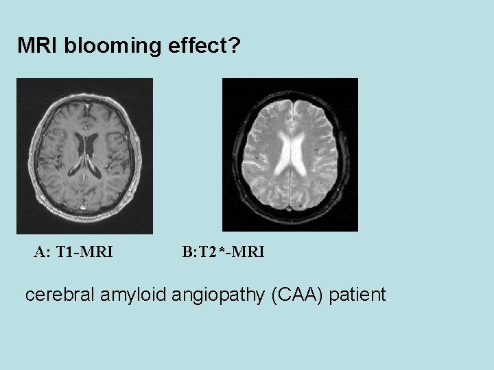 MRI blooming effect? A: T 1 -MRI B: T 2*-MRI cerebral amyloid angiopathy (CAA)
