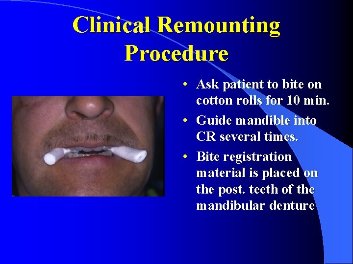 Clinical Remounting Procedure • Ask patient to bite on cotton rolls for 10 min.