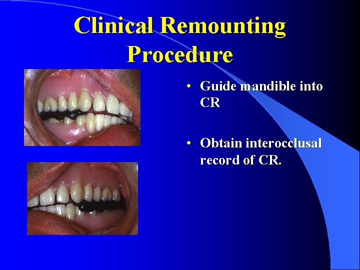 Clinical Remounting Procedure • Guide mandible into CR • Obtain interocclusal record of CR.