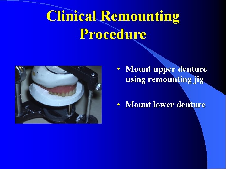 Clinical Remounting Procedure • Mount upper denture using remounting jig • Mount lower denture