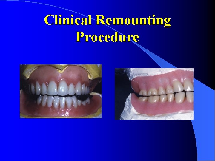 Clinical Remounting Procedure 