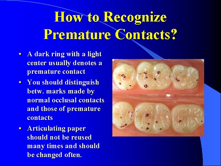 How to Recognize Premature Contacts? • A dark ring with a light center usually