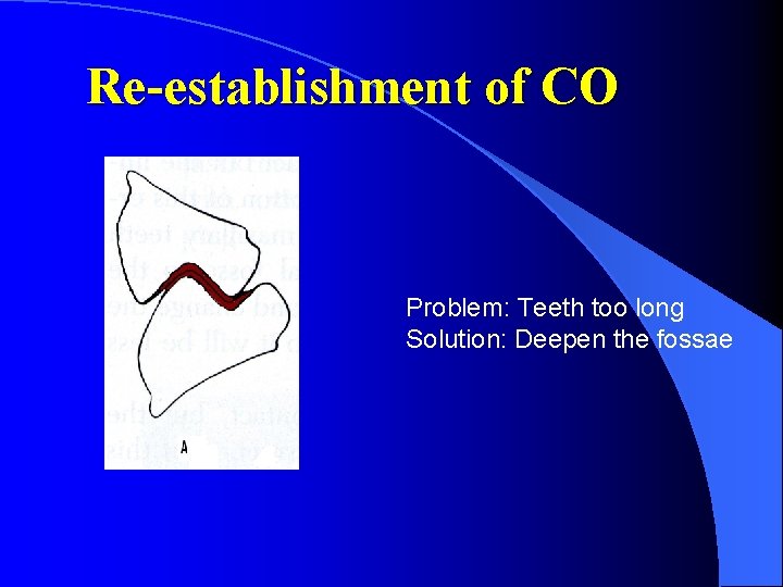 Re-establishment of CO Problem: Teeth too long Solution: Deepen the fossae 