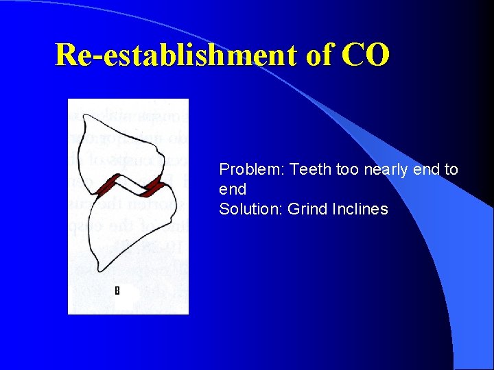 Re-establishment of CO Problem: Teeth too nearly end to end Solution: Grind Inclines 