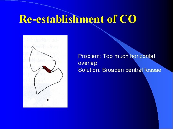 Re-establishment of CO Problem: Too much horizontal overlap Solution: Broaden central fossae 