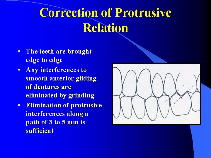 Correction of Protrusive Relation • The teeth are brought edge to edge • Any