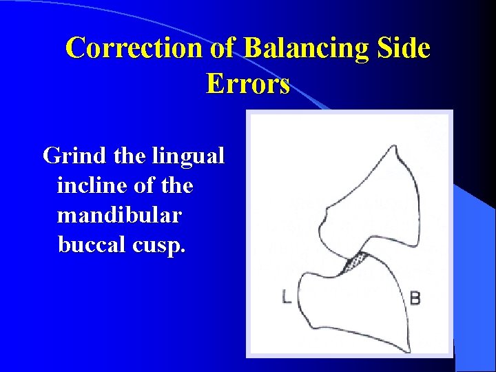 Correction of Balancing Side Errors Grind the lingual incline of the mandibular buccal cusp.