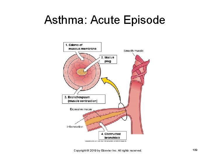 Asthma: Acute Episode Copyright © 2019 by Elsevier Inc. All rights reserved. 109 