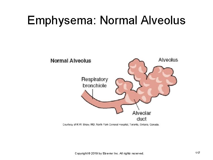 Emphysema: Normal Alveolus Copyright © 2019 by Elsevier Inc. All rights reserved. 117 