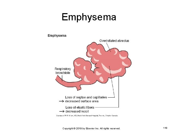 Emphysema Copyright © 2019 by Elsevier Inc. All rights reserved. 118 