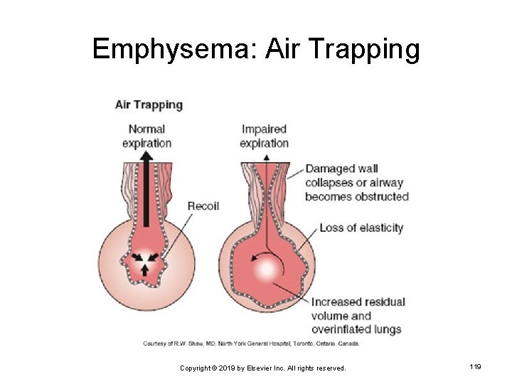 Emphysema: Air Trapping Copyright © 2019 by Elsevier Inc. All rights reserved. 119 